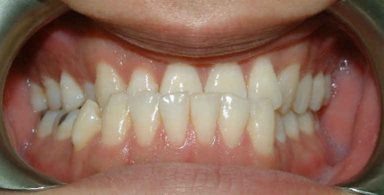 underbite rows orthodontic