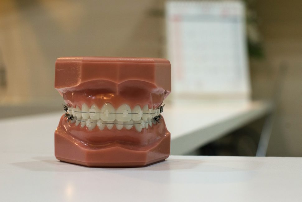Invisalign vs Traditional Braces: Which is Better?