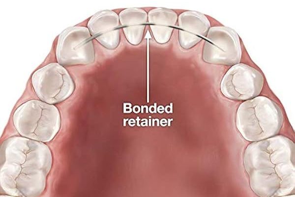 Bonded Retainer